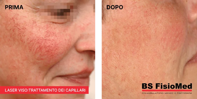 
Laser viso: trattamento dei capillari - BsFisiomed