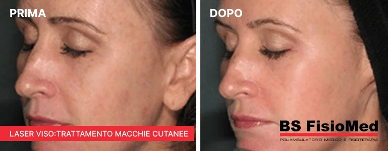 
Laser viso: trattamento delle macchie cutanee - BsFisiomed